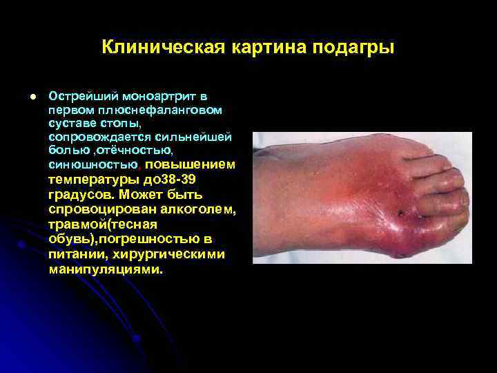 Клиническая картина подагры l Острейший моноартрит в первом плюснефаланговом суставе стопы, сопровождается сильнейшей болью