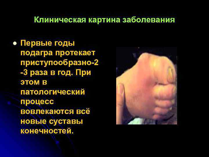 Клиническая картина заболевания l Первые годы подагра протекает приступообразно-2 -3 раза в год. При