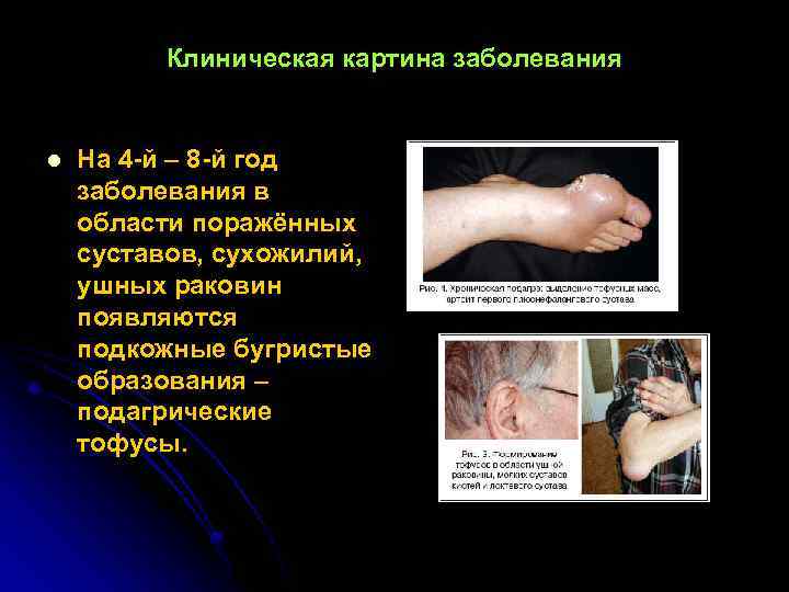 Клиническая картина заболевания l На 4 -й – 8 -й год заболевания в области