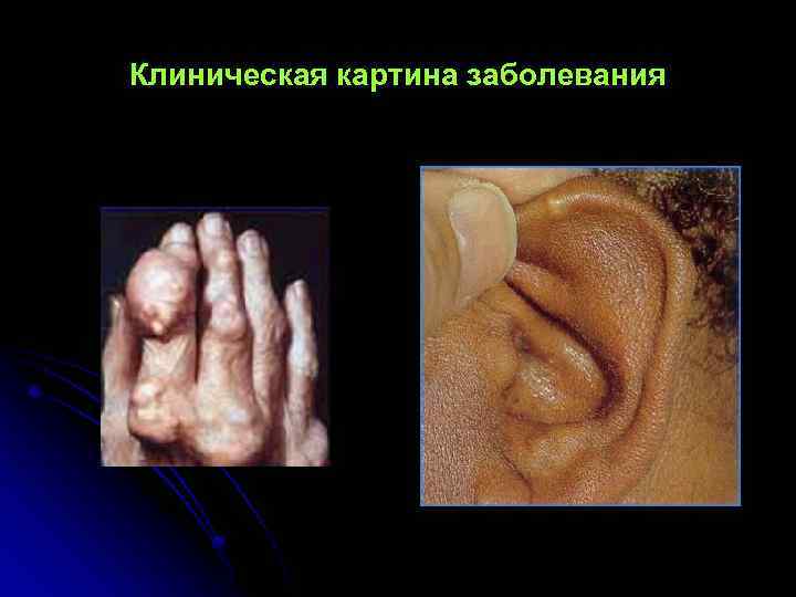 Клиническая картина заболевания 