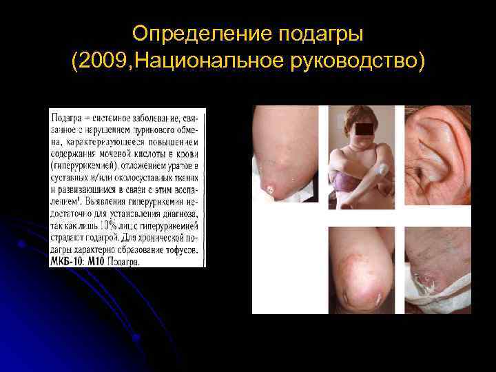 Определение подагры (2009, Национальное руководство) 