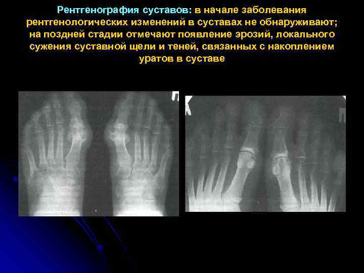 Рентген картина при подагре