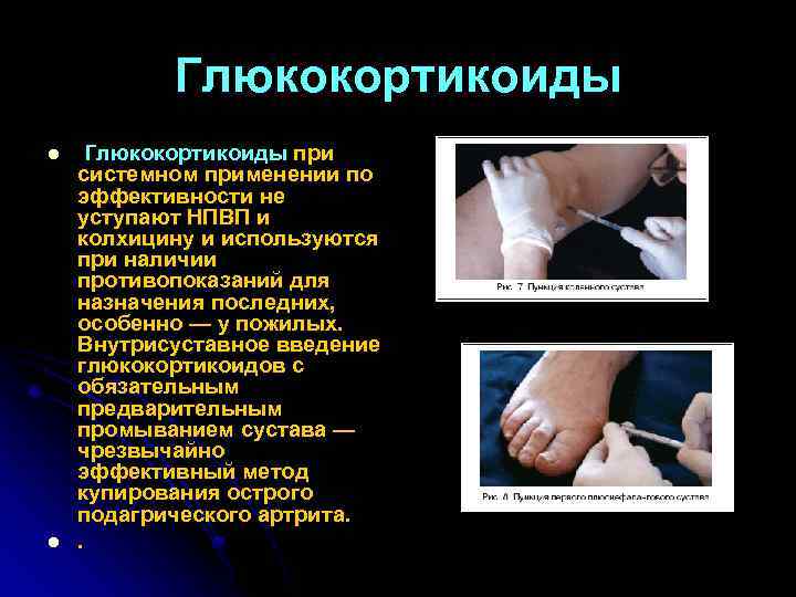 Глюкокортикоиды l l Глюкокортикоиды при системном применении по эффективности не уступают НПВП и колхицину