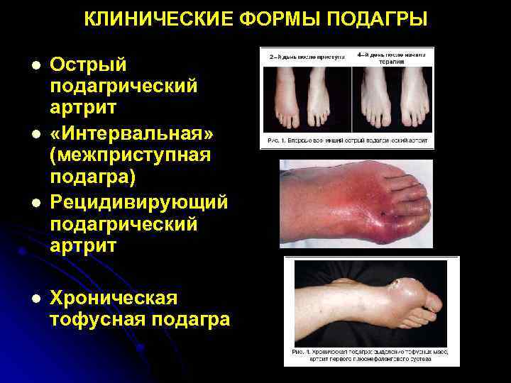КЛИНИЧЕСКИЕ ФОРМЫ ПОДАГРЫ l l Острый подагрический артрит «Интервальная» (межприступная подагра) Рецидивирующий подагрический артрит