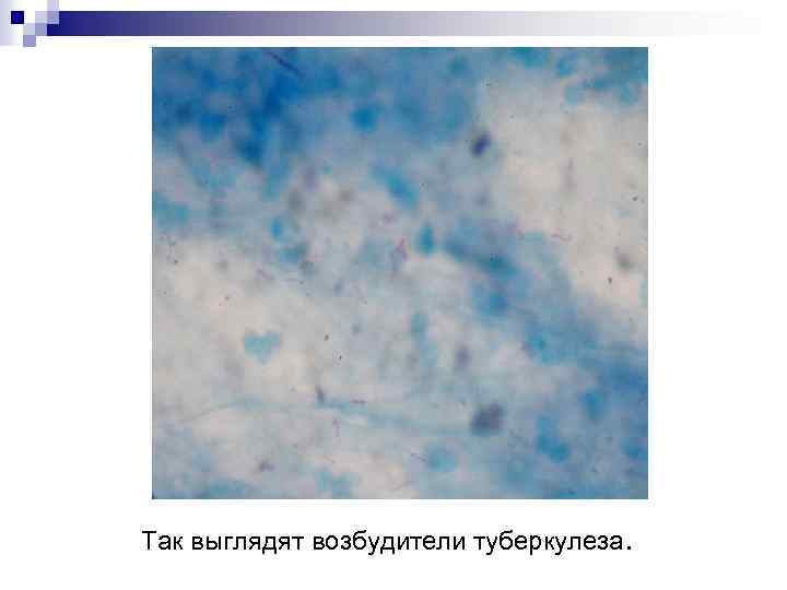 Так выглядят возбудители туберкулеза. 
