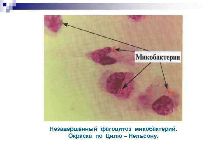 Незавершенный фагоцитоз микобактерий. Окраска по Цилю – Нельсону. 