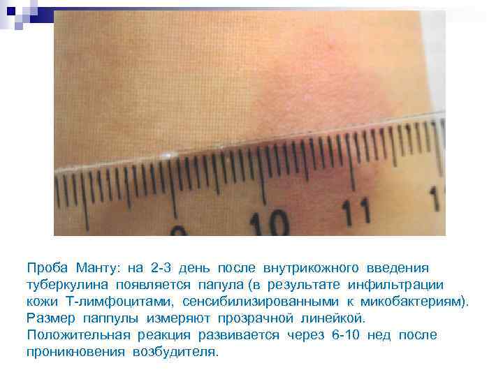 Проба Манту: на 2 -3 день после внутрикожного введения туберкулина появляется папула (в результате