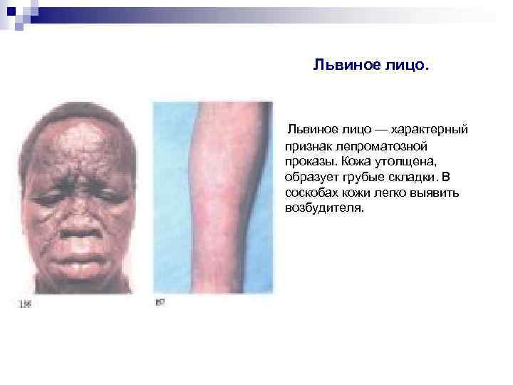 Львиное лицо. Львиное лицо — характерный признак лепроматозной проказы. Кожа утолщена, образует грубые складки.