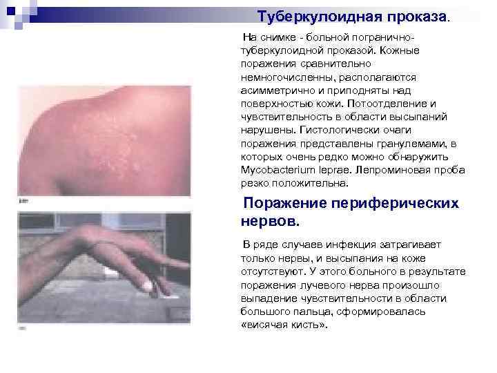 Туберкулоидная проказа. На снимке - больной пограничнотуберкулоидной проказой. Кожные поражения сравнительно немногочисленны, располагаются асимметрично