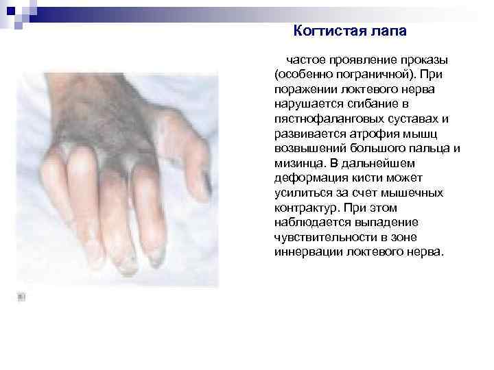 Когтистая лапа частое проявление проказы (особенно пограничной). При поражении локтевого нерва нарушается сгибание в
