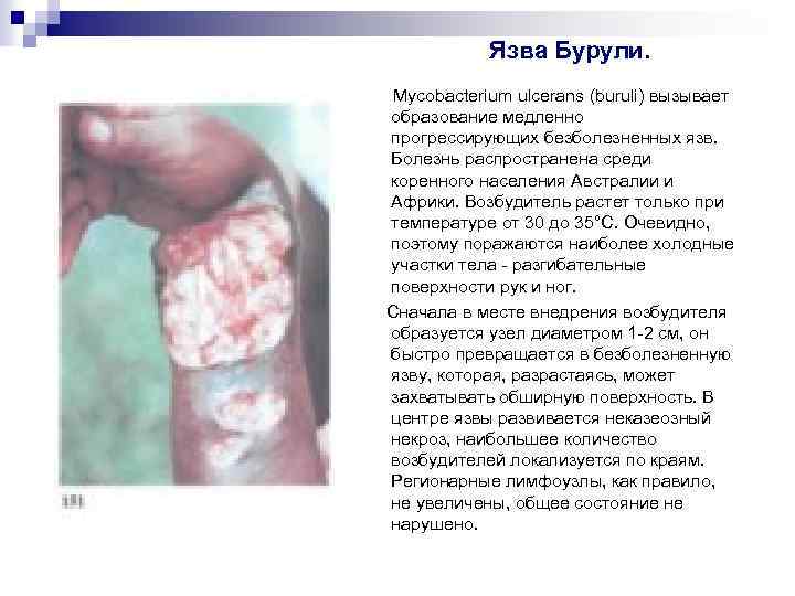 Язва Бурули. Mycobacterium ulcerans (buruli) вызывает образование медленно прогрессирующих безболезненных язв. Болезнь распространена среди