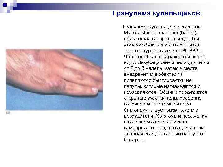 Гранулема купальщиков. Гранулему купальщиков вызывает Mycobacterium marinum (balnei), обитающая в морской воде. Для этих