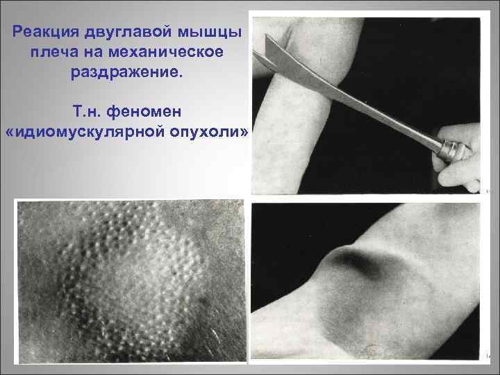 Реакция двуглавой мышцы плеча на механическое раздражение. Т. н. феномен «идиомускулярной опухоли» 