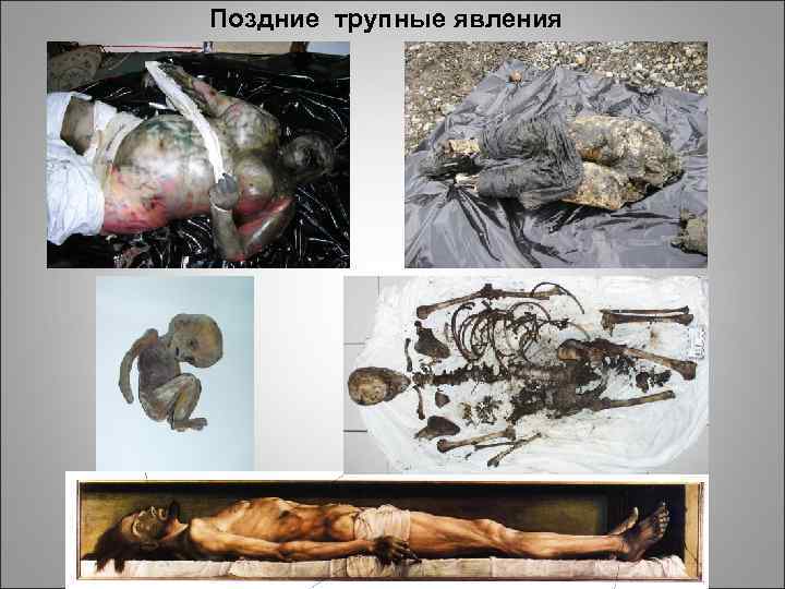 Поздние трупные явления 