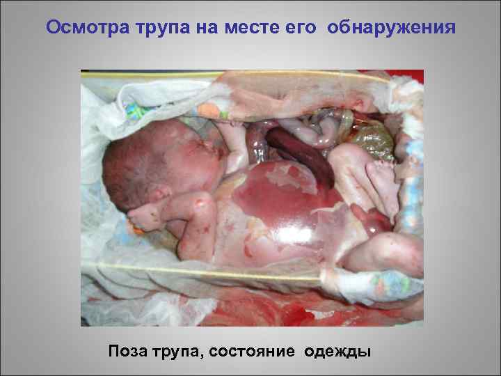 Осмотра трупа на месте его обнаружения Поза трупа, состояние одежды 