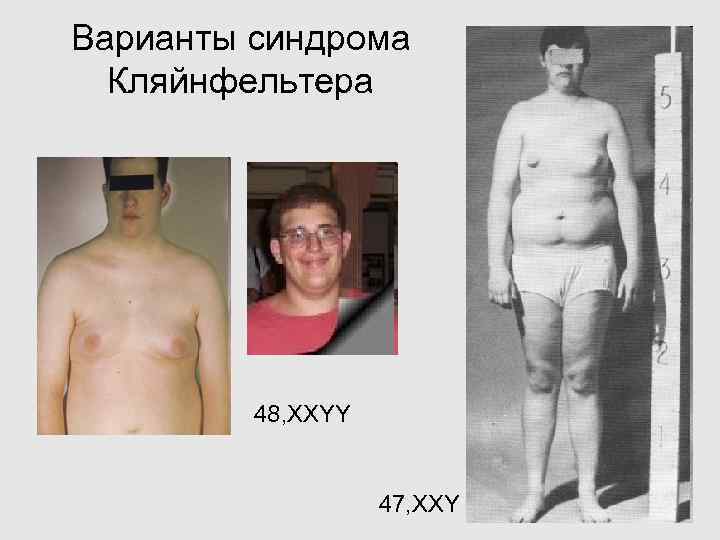 Варианты синдрома Кляйнфельтера 48, XXYY 47, XXY 