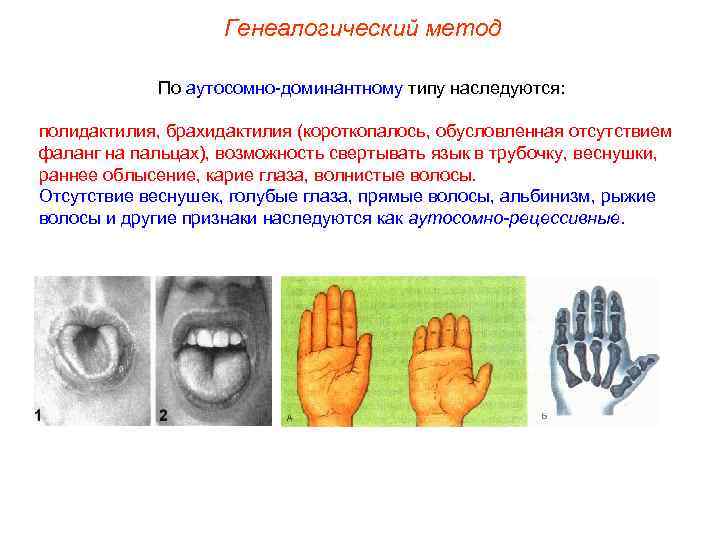 Генеалогический метод По аутосомно-доминантному типу наследуются: полидактилия, брахидактилия (короткопалось, обусловленная отсутствием фаланг на пальцах),