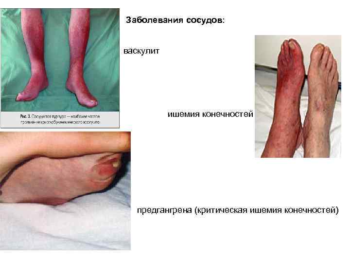 Заболевания сосудов: васкулит ишемия конечностей предгангрена (критическая ишемия конечностей) 