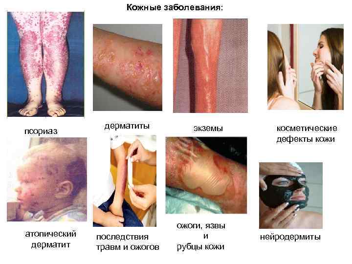  Кожные заболевания: дерматиты экземы косметические псориаз дефекты кожи ожоги, язвы атопический последствия и