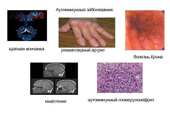  Аутоиммунные заболевания: красная волчанка ревматоидный артрит болезнь Крона миастения аутоиммунный гломерулонефрит 