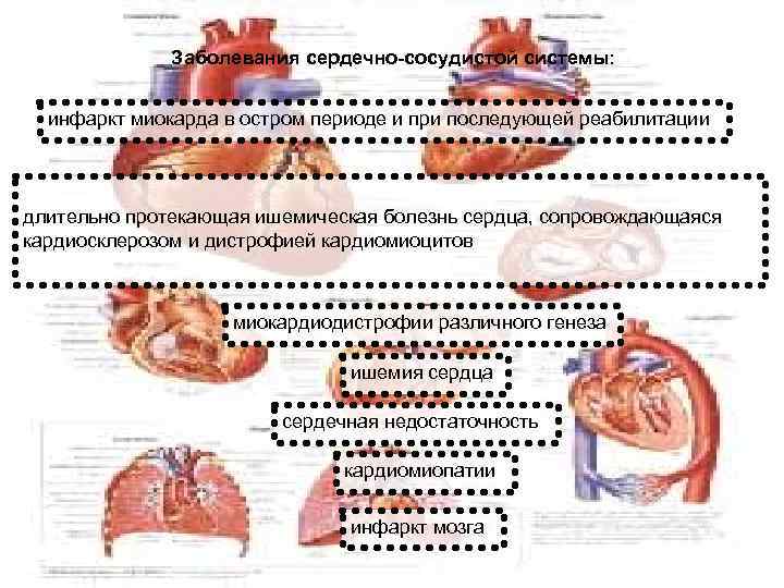  Заболевания сердечно-сосудистой системы: инфаркт миокарда в остром периоде и при последующей реабилитации длительно