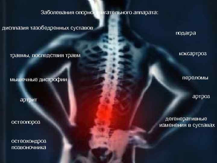 Заболевания опорно двигательного аппарата