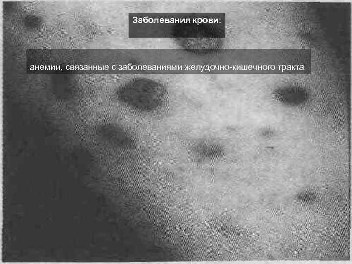  Заболевания крови: анемии, связанные с заболеваниями желудочно-кишечного тракта 