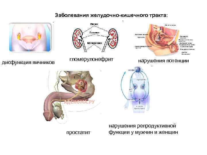  Заболевания желудочно-кишечного тракта: гломерулонефрит нарушения потенции дисфункция яичников нарушения репродуктивной простатит функции у