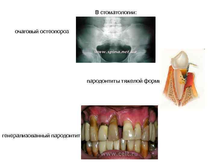  В стоматологии: очаговый остеопороз пародонтиты тяжелой формы генерализованный пародонтит 