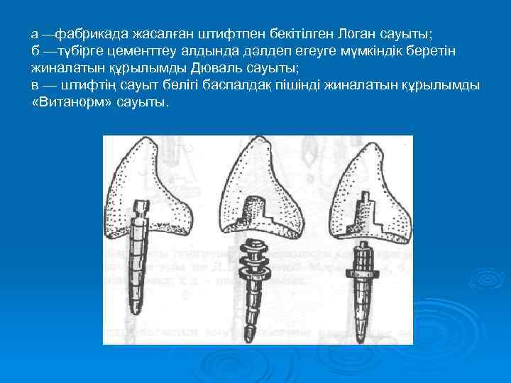 а —фабрикада жасалған штифтпен бекітілген Логан сауыты; б —түбірге цементтеу алдында дәлдеп егеуге мүмкіндік