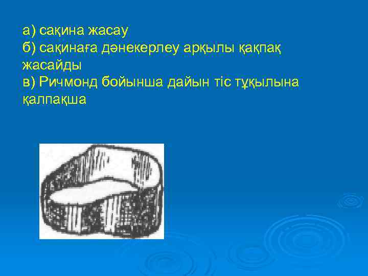 а) сақина жасау б) сақинаға дәнекерлеу арқылы қақпақ б) жасайды в) Ричмонд бойынша дайын