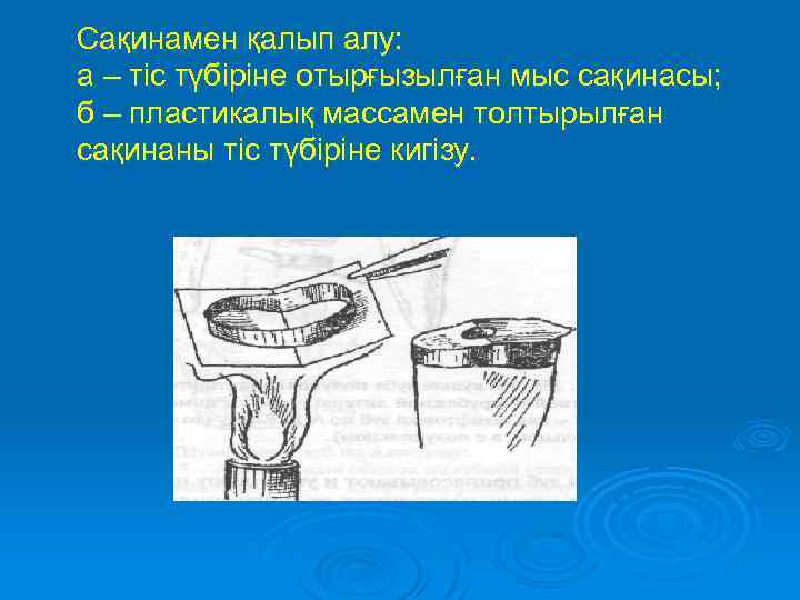 Сақинамен қалып алу: а – тіс түбіріне отырғызылған мыс сақинасы; б – пластикалық массамен