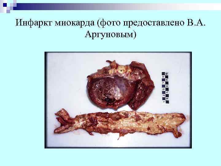 Инфаркт миокарда (фото предоставлено В. А. Аргуновым) 