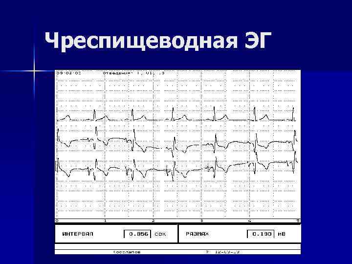 Чреспищеводная ЭГ 