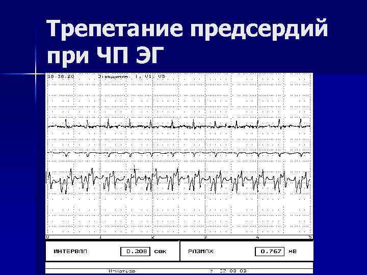 Трепетание предсердий при ЧП ЭГ 