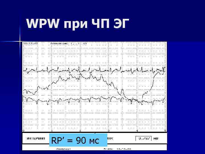 WPW при ЧП ЭГ RP’ = 90 мс 