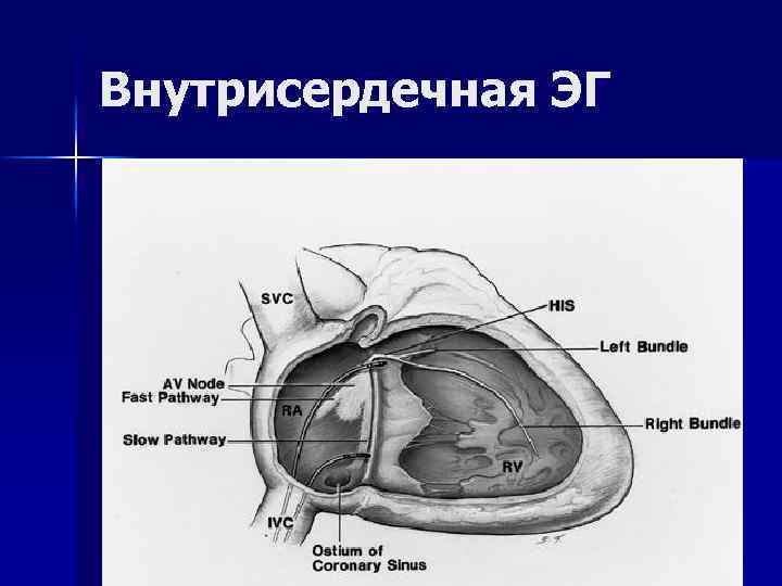 Внутрисердечная ЭГ 