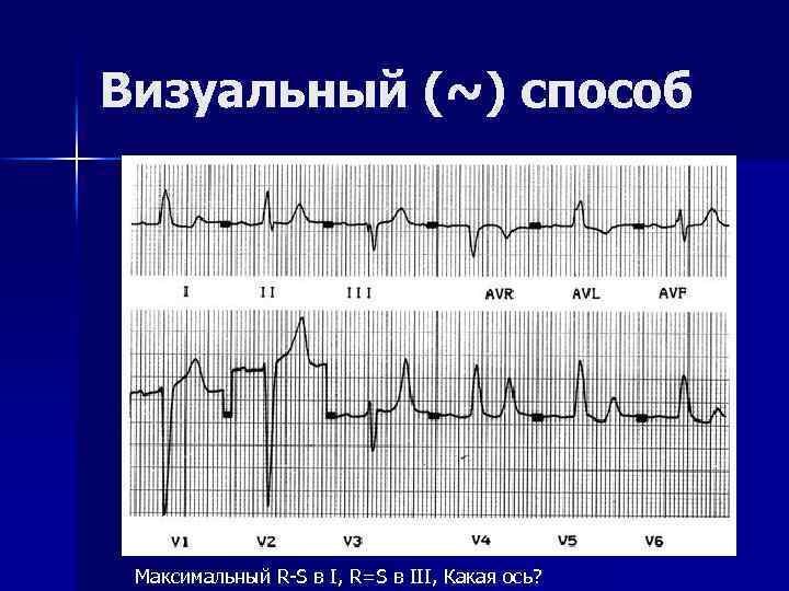 Визуальный (~) способ Максимальный R-S в I, R=S в III, Какая ось? 