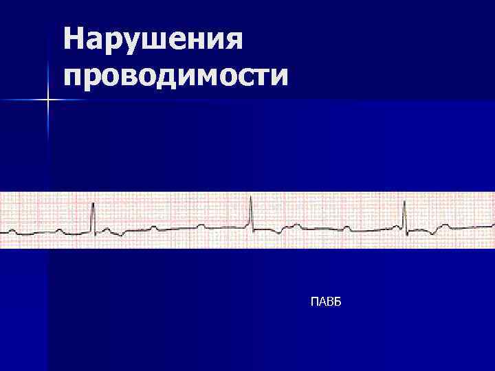 Нарушения проводимости ПАВБ 