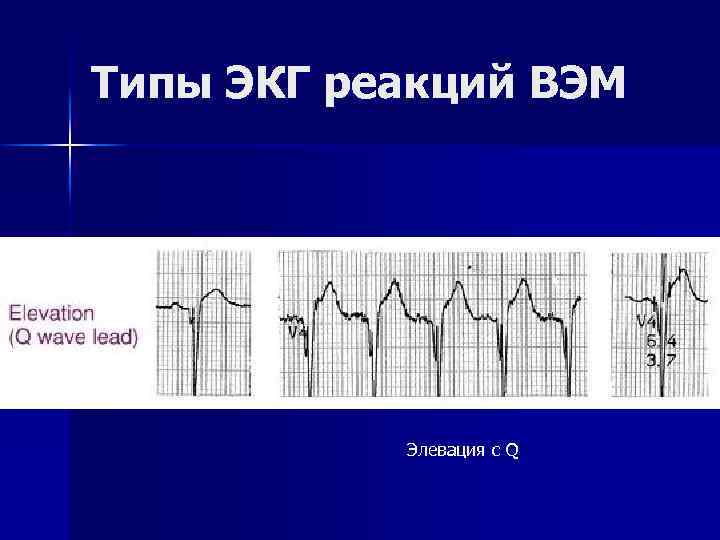 Типы ЭКГ реакций ВЭМ Элевация с Q 