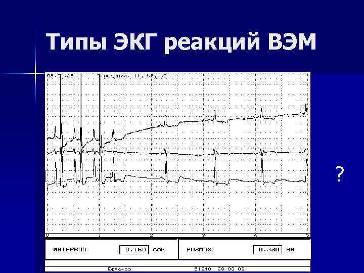 Типы ЭКГ реакций ВЭМ ? 