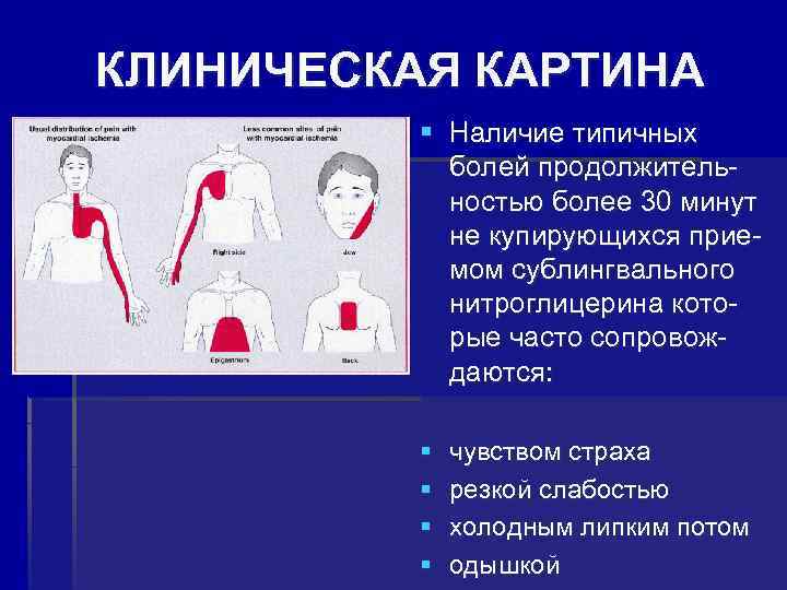 КЛИНИЧЕСКАЯ КАРТИНА § Наличие типичных болей продолжитель- ностью более 30 минут не купирующихся прие-