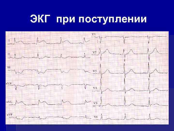 ЭКГ при поступлении 