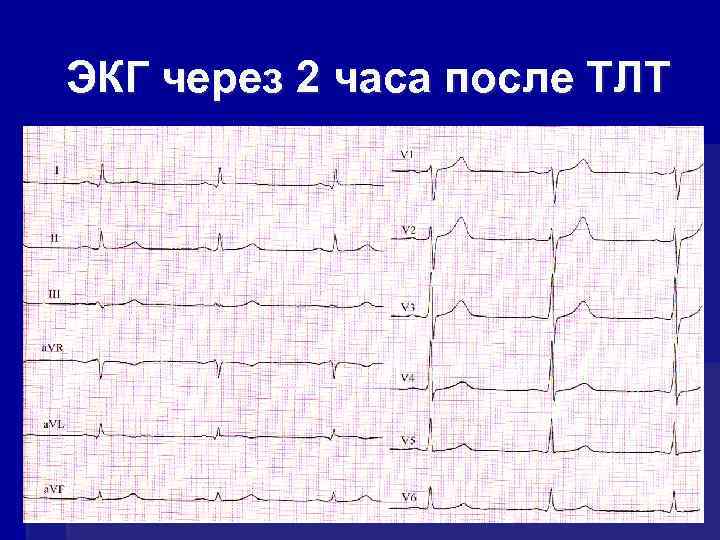 ЭКГ через 2 часа после ТЛТ 