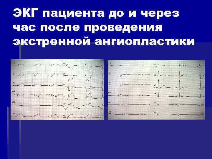 ЭКГ пациента до и через час после проведения экстренной ангиопластики 