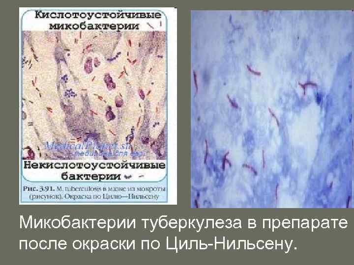 Микобактерии туберкулеза в препарате после окраски по Циль-Нильсену. 