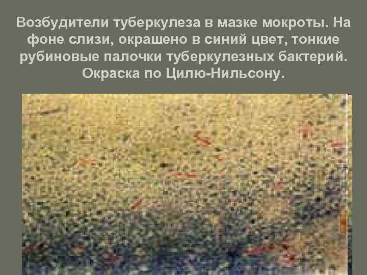 Возбудители туберкулеза в мазке мокроты. На фоне слизи, окрашено в синий цвет, тонкие рубиновые