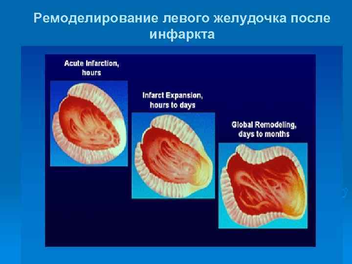 Концентрическое ремоделирование стенок лж