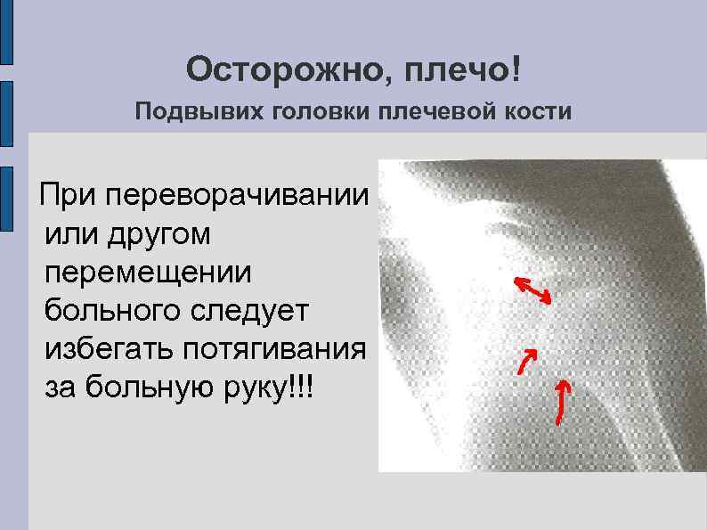 Осторожно, плечо! Подвывих головки плечевой кости При переворачивании или другом перемещении больного следует избегать