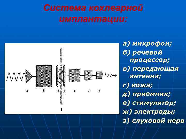 Система кохлеарной имплантации: а) микрофон; б) речевой процессор; в) передающая антенна; г) кожа; д)